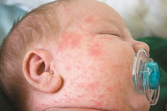 Mùa Tết - Đông Xuân: Sởi lây lan nhanh, trẻ chưa tiêm vaccine nguy cơ cao