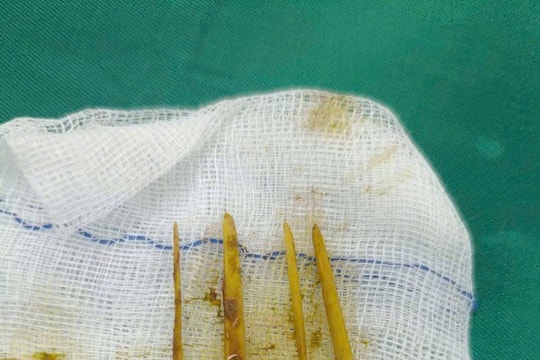 Ăn cỗ cưới, cô gái 26 tuổi vô tình nuốt 3 que tăm xiên thịt