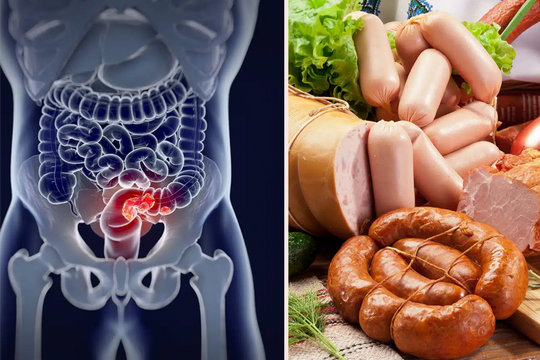Nhiều người không biết loại thực phẩm phổ biến này làm tăng nguy cơ ung thư