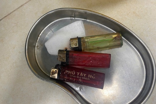 Bất ngờ phát hiện 3 chiếc bật lửa trong dạ dày người bệnh