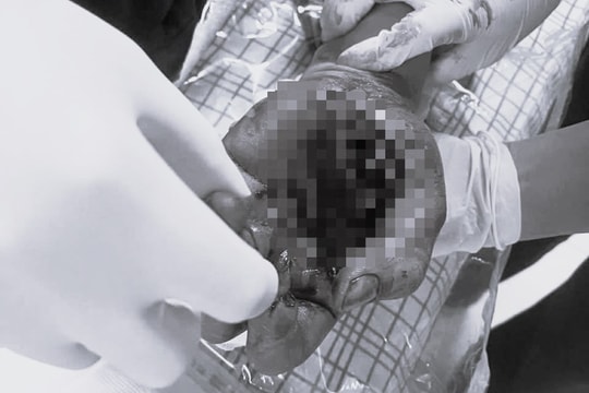 Pháo phát nổ ngay trên tay, nam thanh niên nhập viện với bàn tay dập nát
