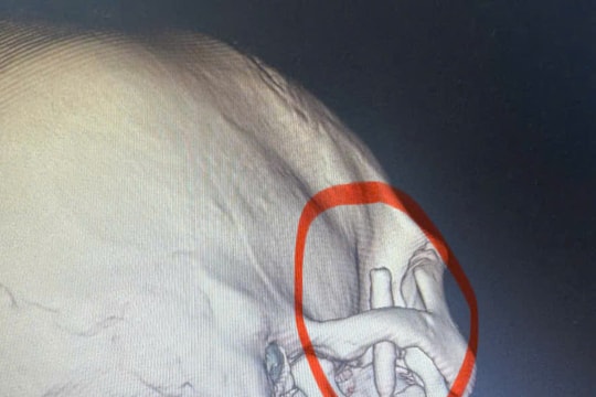 Hy hữu: Dị vật bút bi nằm sâu trong vùng thái dương suốt 13 năm