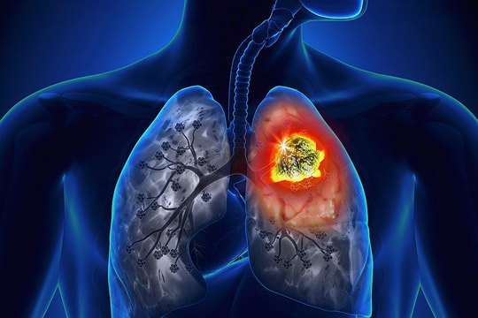 Phát hiện sớm ung thư phổi từ những “nốt mờ” nhỏ bằng hạt đậu