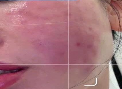 Tiêm meso tại nhà, người phụ nữ nhập viện vì biến chứng nặng