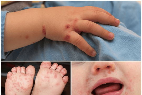 Bệnh lây nhiễm tay chân miệng tăng cao, Bộ Y tế chỉ đạo khẩn
