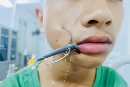 Tai nạn khi câu cá, bé trai nhập viện vì lưỡi câu móc vào mặt