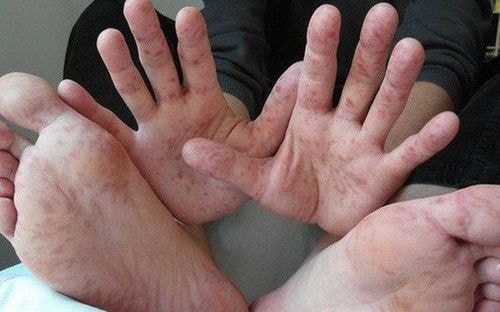 Đã có 8 ca tử vong do dịch tay chân miệng, Bộ Y tế khuyến cáo phòng bệnh