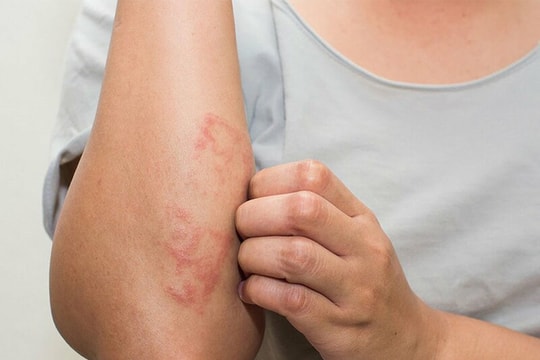 Viêm mao mạch dị ứng: Không quá đáng sợ nhưng cần nhận biết đúng bệnh