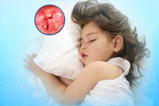Ngưng thở khi ngủ do amidan quá phát ở trẻ nhỏ, phụ huynh không nên chủ quan
