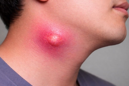 Áp xe cổ đe dọa tính mạng người bệnh nếu phát hiện muộn