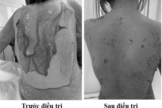 Tự uống thuốc dị ứng, người phụ nữ bị “lột da” toàn thân vì hội chứng hiếm gặp