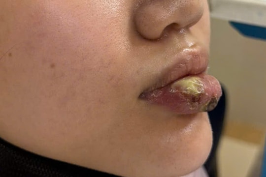 Tiêm “giải filler” tại cơ sở không phép, người phụ nữ biến dạng môi