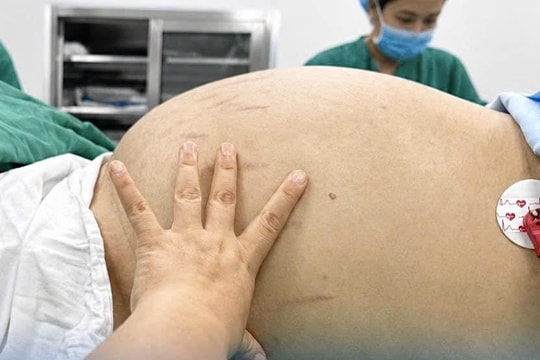 Cô gái 19 tuổi mang khối u buồng trứng gần 30cm chỉ vì tưởng tăng cân
