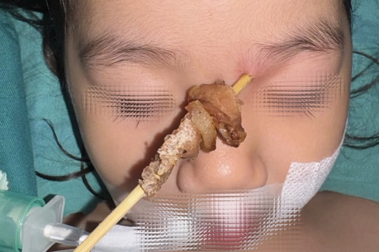 Hy hữu: Bé gái bị que xiên thịt đâm sâu, nguy cơ xuyên sọ não
