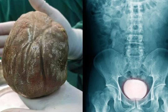 Đau đớn mang “khối đá” 1,3kg trong cơ thể suốt nhiều năm vì ngại đi khám