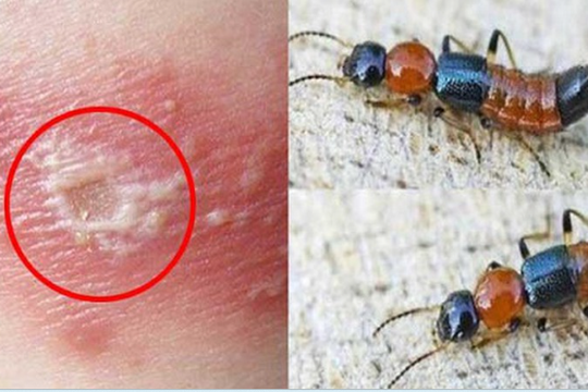 Bác sĩ chỉ cách phân biệt viêm da do kiến ba khoang và zona thần kinh