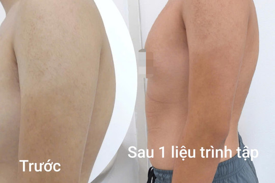 Thói quen ngồi học sai nhiều năm khiến cột sống nam sinh gù vẹo nghiêm trọng