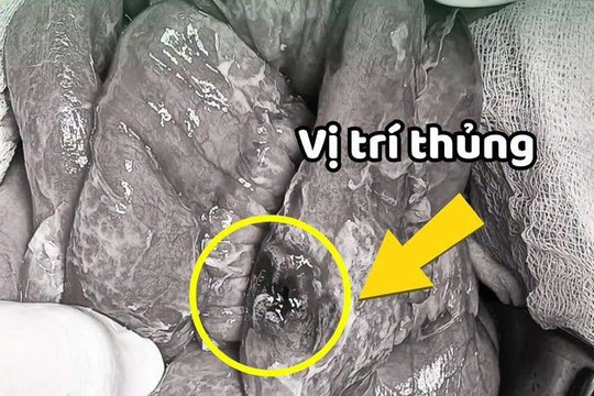 Chủ quan trước cơn đau bụng, người đàn ông bất ngờ phát hiện ung thư hiếm gặp