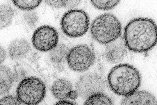 Hantavirus trở lại Nam Mỹ: Chile báo động khi gần 40% ca mắc tử vong