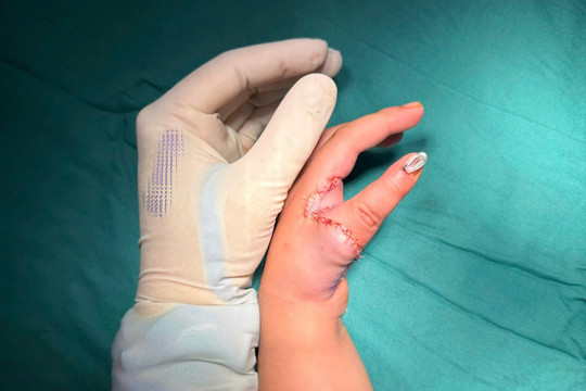 Tái tạo ngón cái từ ngón trỏ, mở ra cơ hội mới cho trẻ mắc dị tật bẩm sinh