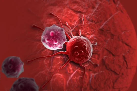 Hoa mắt, chóng mặt, người phụ nữ mắc ung thư máu cấp tính