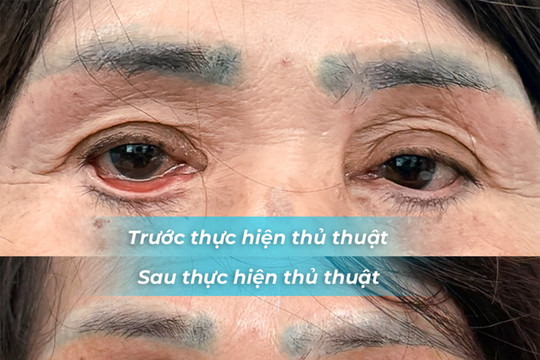 Lật mi hai bên sau khi phẫu thuật thẩm mỹ tại cơ sở làm đẹp