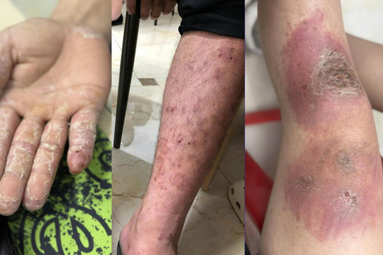 Bác sĩ chỉ nguyên nhân lội nước vài giờ có thể khiến da tổn thương