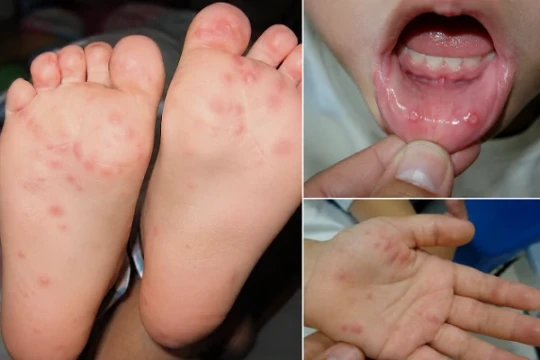 An Giang: Tập trung phòng, chống dịch bệnh sốt xuất huyết, tay chân miệng