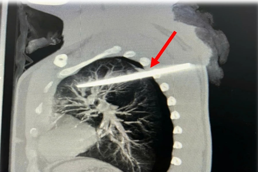 Cấp cứu kịp thời người đàn ông nguy kịch do vết thương thấu ngực, kèm dị vật sâu trong phổi