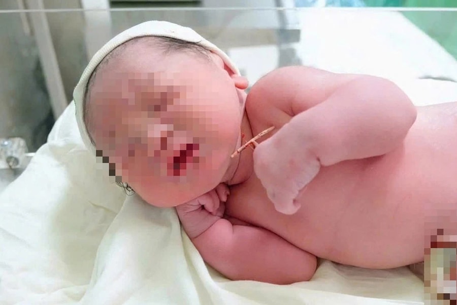 Hy hữu: Bé gái chào đời cùng vòng tránh thai của mẹ 