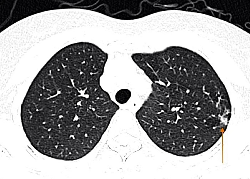 Tự mua thuốc cảm cúm, người phụ nữ nhập viện vì biến chứng viêm phổi: Bác sĩ cảnh báo! 