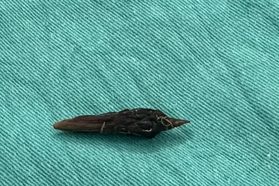 Ăn yến chưng cùng hạt táo đỏ, người phụ nữ bị thủng ruột