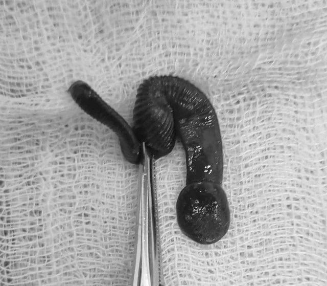 Bác sĩ gắp con vắt dài 8cm trong mũi người đàn ông do uống nước ở khe suối