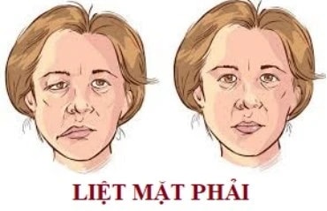 Người dân cần làm gì để đối phó liệt mặt do lạnh tăng ? 