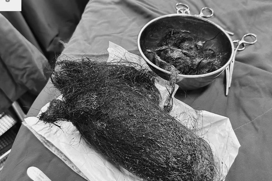 Phẫu thuật lấy búi tóc khổng lồ gần 1kg trong dạ dày bé gái