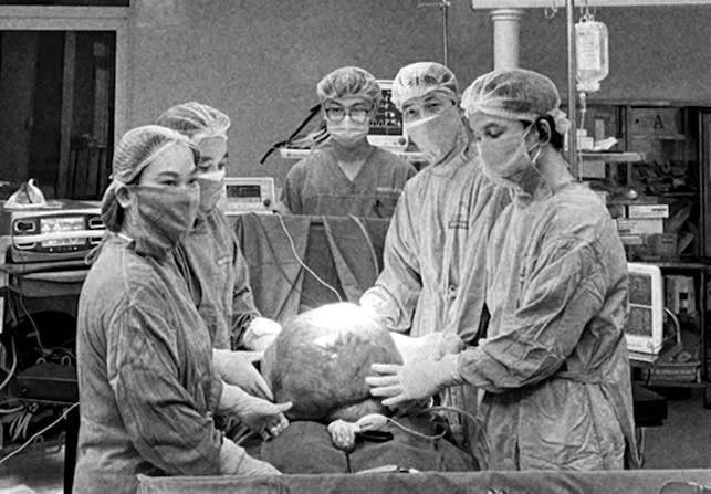 Uống thuốc nam không rõ nguồn gốc, người phụ nữ có khối u khổng lồ nặng 15 kg ở bụng 