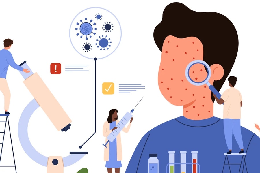 Bộ Y tế khuyến cáo 5 biện pháp phòng bệnh sởi