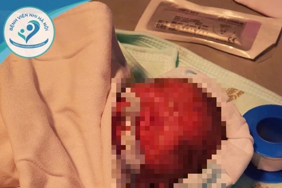 Sơ sinh bị đẻ rơi nặng 900g hồi phục sự sống kỳ diệu trước "cửa tử"