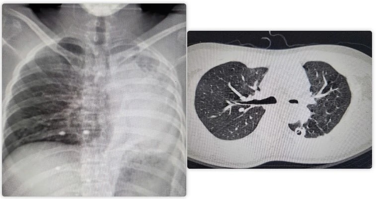 Phẫu thuật thành công hồi sinh lá phổi xẹp hoàn toàn cho nam bệnh nhân
