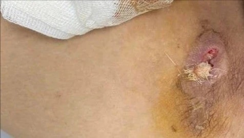 Thanh Hoá: Phát hiện người đàn ông bị nhiễm vi khuẩn ăn thịt người 