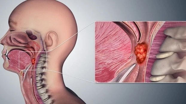 Bác sĩ Bệnh viện K chỉ ra dấu hiệu nhận biết ung thư vòm hầu
