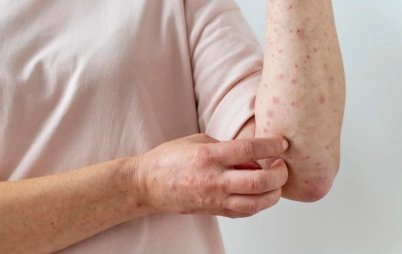 Bộ Y tế khuyến cáo phòng, chống bệnh sởi đối với nhóm có nguy cơ diễn biến nặng 