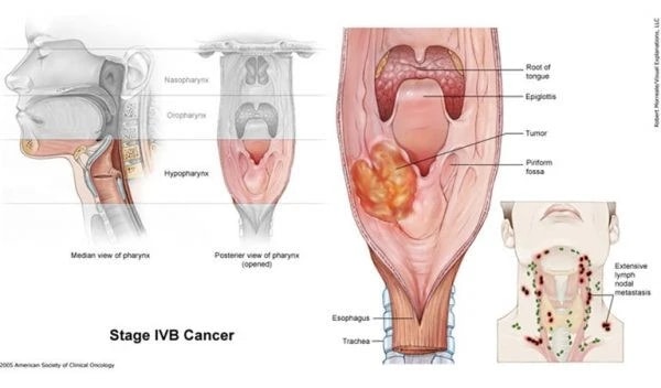 Nguyên nhân gây ung thư vòm họng ở phụ nữ 