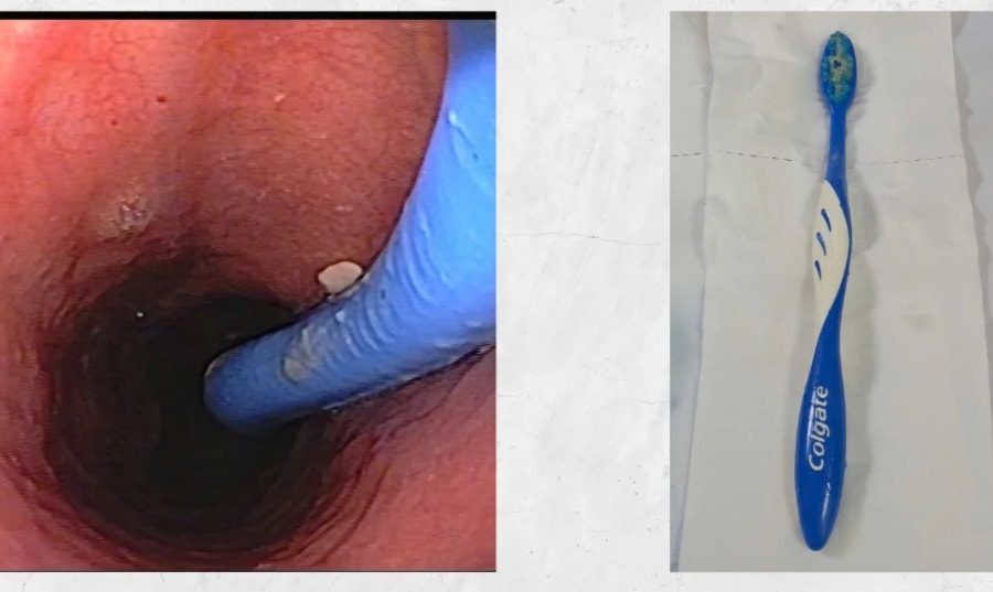 Hy hữu: Người phụ nữ vô tình nuốt bàn chải đánh răng dài 17cm vào thực quản