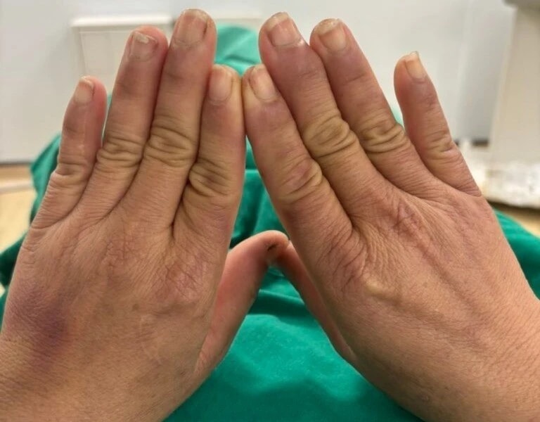 Căn bệnh lạ khiến người phụ nữ đau đớn mỗi khi chạm tay vào nước