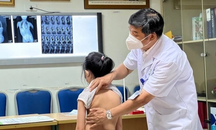 Bệnh viện Hữu nghị Việt Đức khám, tư vấn miễn phí bệnh lý gù vẹo cột sống ở trẻ em