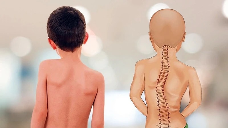 Bệnh viện Hữu nghị Việt Đức khám, tư vấn miễn phí bệnh gù vẹo cột sống