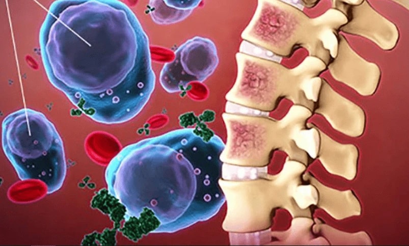  Đa u tủy xương một bệnh máu ác tính