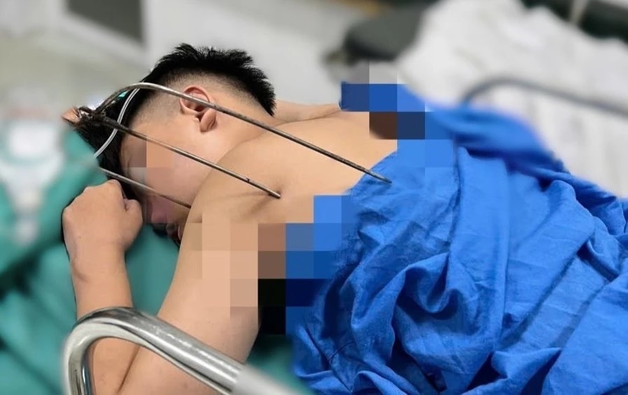 Cứu sống nam thanh niên 17 tuổi bị dị vật kim loại xuyên thấu tim