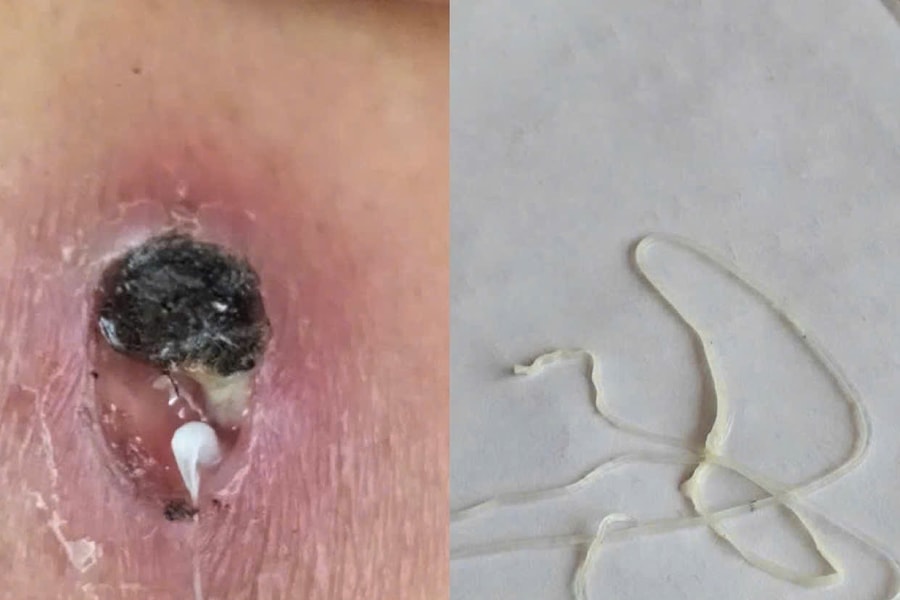 Phát hiện ca bệnh giun rồng hiếm gặp tại Phú Thọ